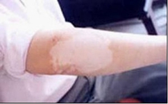 为什么白癜风久治不愈呢