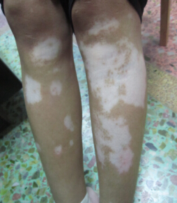 武汉哪里看白癜风好