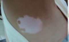 武汉市治白癜风哪里较好