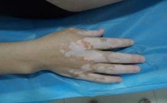 武汉在哪里可以治疗白癜风