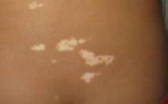 武汉治白癜风到哪里