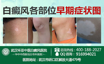 孝感白癜风专科哪里好