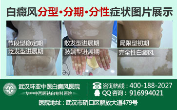 黄冈白癜风哪里看的好