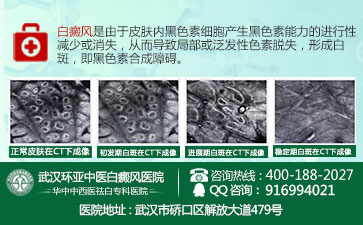 黄冈白癜风哪家治疗较好