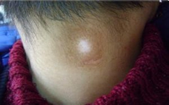 白癜风的主要治疗方法有哪些