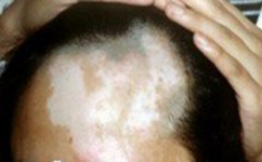 怎样能使老人的白斑消失