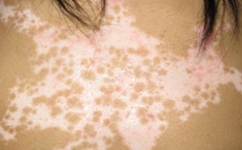 哪些方法可以有效的辅助白癜风的治疗