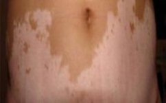 白癜风多发部位主要在哪里