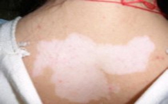 胳膊上有小白点的危害