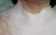 导致白癜风疾病常见的病因