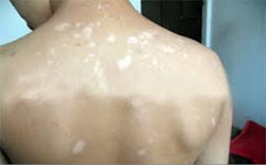 生活中如何护理治疗白癜风