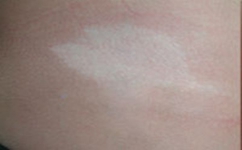 如何避免白癜风患者心理波动