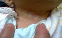 预防儿童白癜风的方法有哪些呢