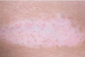 白癜风的危害要哪些