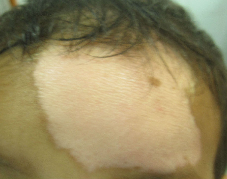 白癜风的危害有哪些