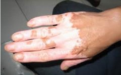 中药偏方治疗白癜风有哪些