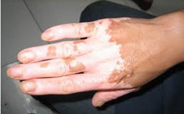 中药偏方治疗白癜风有哪些