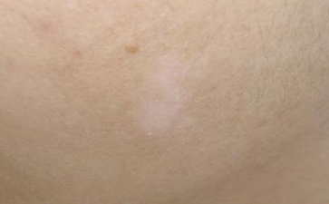 青少年白癜风是怎么诊断的