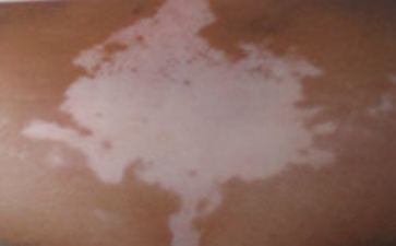 儿童白癜风危害有哪些