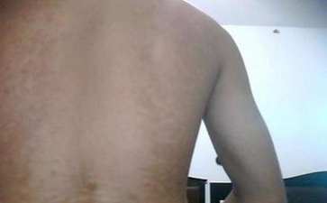 白癜风治疗不及时有哪些危害