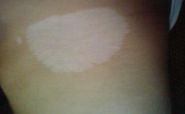 白癜风的诊断依据是什么