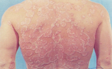 青少年白癜风如何治疗