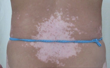 Å®ÐÔ°×ñ°·ç»¼ÕßÒªÔõôÖÎÁÆ