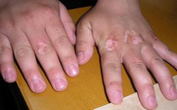 白癜风患者如何治疗