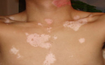 最初白癜风的症状是什么