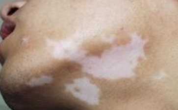 白癜风患者应该如何调节心理问题