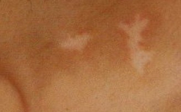 白癜风初期如何饮食