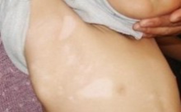 男性白癜风如何才能康复