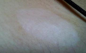 白癜风的发病会有哪些危害