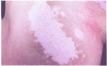 成人治疗白癜风的原则是什么