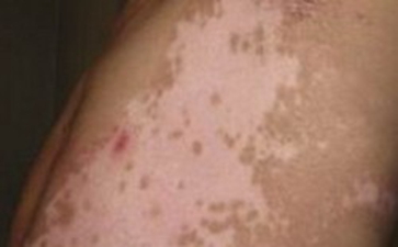 青少年怎样面对白癜风