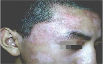 面部白癜风的治疗方法有哪些