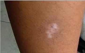 白癜风出现的原因是什么