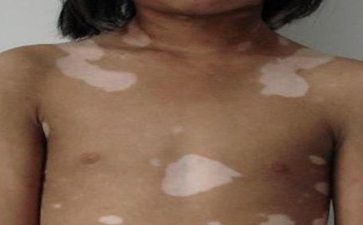 白癜风的养生调理知识