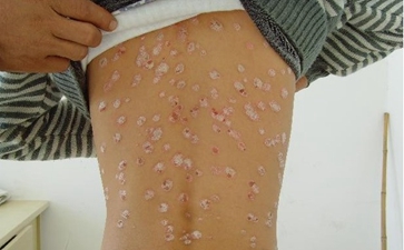 白癜风的检查事项有哪些