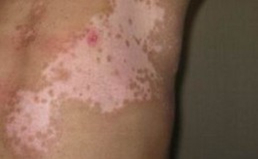 白癜风宝宝如何正确饮食