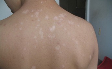 白癜风会对患者的心理造成什么影响