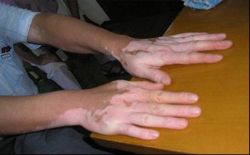 白癜风的危害都有哪些