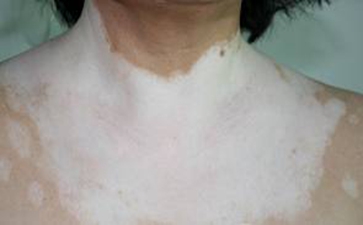 白癜风治疗偏方可信吗