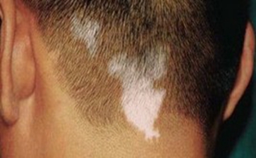 男性白癜风治疗的注意事项是什么