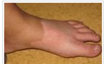 成人白癜风是如何引起的