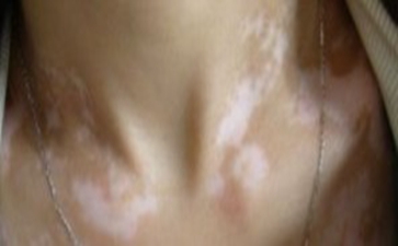 女孩子得了白癜风怎么办