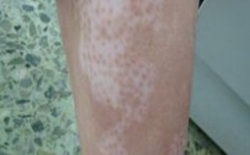 白癜风患者如何护理