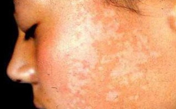 什么部位容易长白癜风