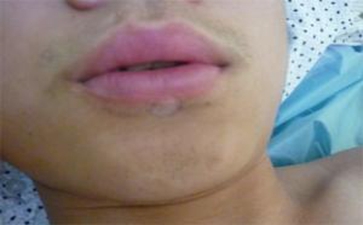 白癫风食疗偏方