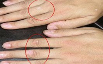 白癜风心理治疗要注意哪些